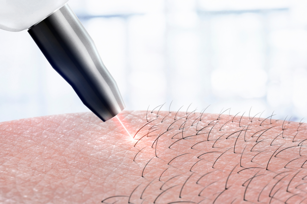 Laser Hair Removal - Broward Dermatology
